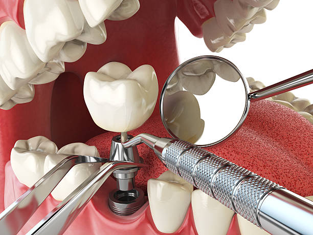 Best Emergency Wisdom Tooth Extraction in Le Grand, CA